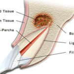 Apicoectomy in India