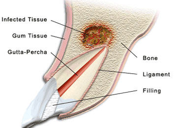 icon_28_8710 apicoectomy-in-india