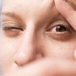 Dry Eye Treatment in India