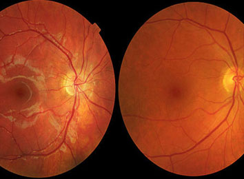 age-related-macular-degeneration