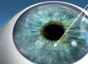 icon_295_9047 intacs-treatment-in-india