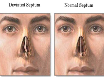 septoplasty-surgery