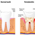 Peridontal Flap Surgery in India