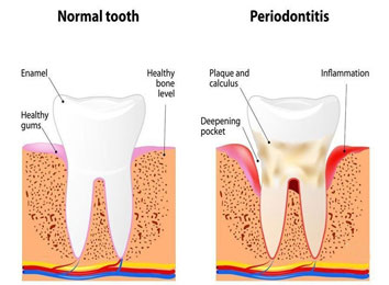 icon_29_883 periodontal-flap-surgery