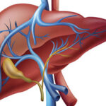 Liver Cirrhosis Treatment in India
