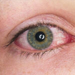 Uveitis Treatment in India