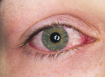 icon_302_5743 uveitis-in-india