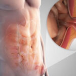 Hernia Treatment in India