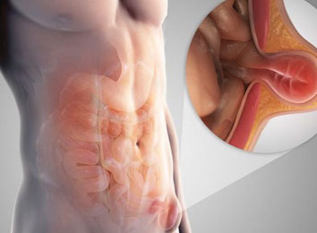hernia-treatment-in-india
