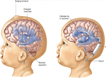 hydrocephalus-treatment-in-india