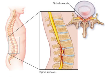 lumbar-spinal-stenosis-surgery-intro
