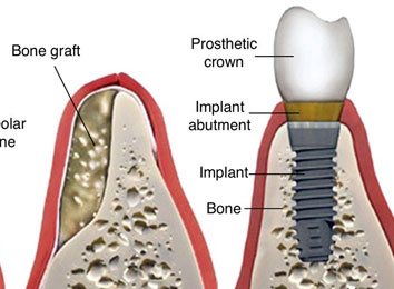 icon_30_9649 bone-grafting