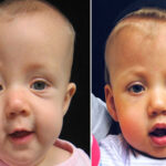 Craniosynostosis Surgery in India