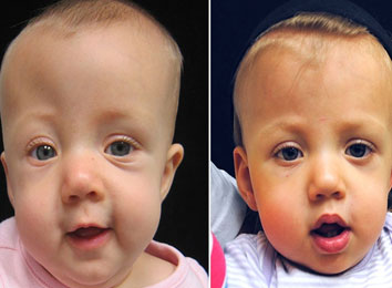 craniosynostosis-surgery