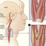 Carotid Artery Disease Treatment in India