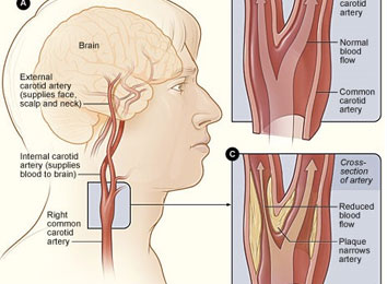 carotid-artery-disease