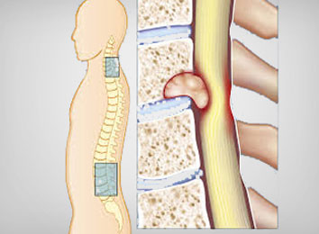 spinal-tumor-surgery-in-india