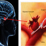 Brain Aneurysm Treatment in India