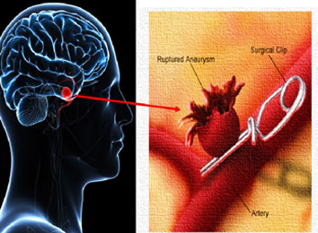 Brain-Aneurysm-Treatment-in-India