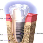 Dental Implant in India