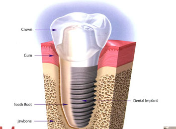 dental-implant-in-india