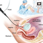 Cystoscopy in India