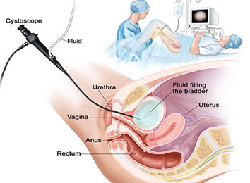 cystoscopy-in-india