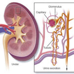 Nephrotic Syndrome Treatment in India