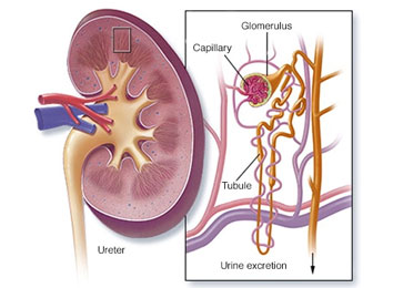 nephrotic-syndrome