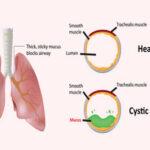 Cystic Fibrosis Treatment in India