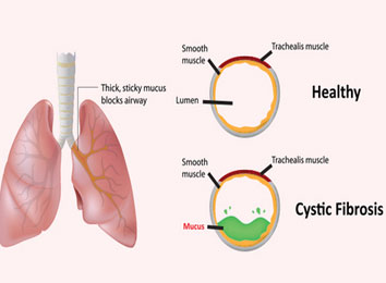 cystic-fibrosis-treatment-in-india