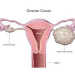 Ovarian Cancer Treatment in India