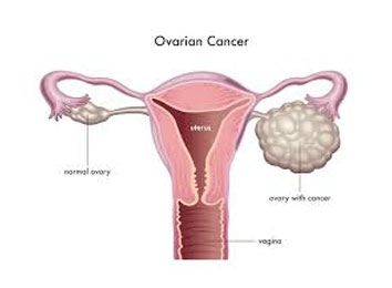 icon_350_1479 Ovarian-Cancer