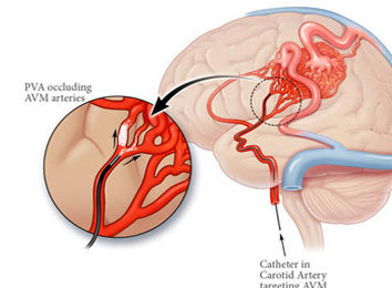 Endovascular-Embolization