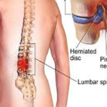 Lumbar Discectomy in India