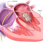 Balloon Aortic Valvuloplasty in India