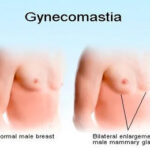 Gynecomastia (Male Breast Reduction) in India