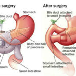 Whipple Procedure in India
