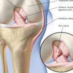 Anterior Cruciate Ligament (ACL) Reconstruction