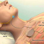 Sleep Apnea Treatment in India