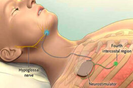 Neck Dissection | Radical Neck Dissection | Neck Dissection Surgery