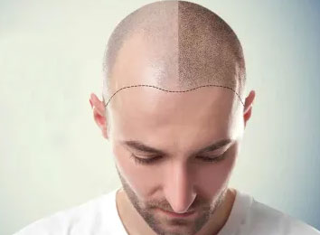 surgical-hair-transplantation-in-india