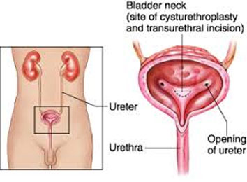 icon_49_6398 bni-bladder-neck-incision-in-india