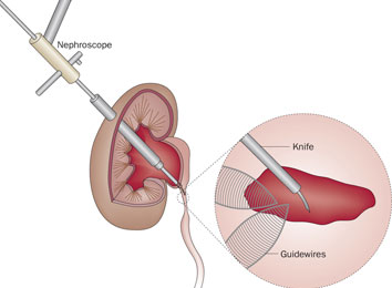endopyelotomy-surgery-in-india