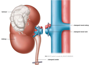 radical-nephrectomy-in-india