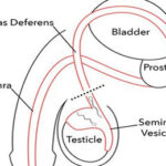 Vasectomy (Male Sterilization) Surgery in India