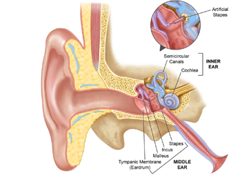 stapedectomy-surgery-in-india