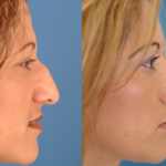 Nasal Surgery in India