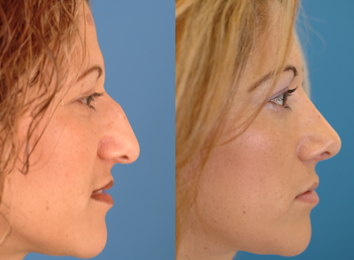 nasal-surgery