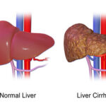 Liver Transplant in India